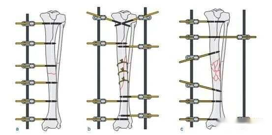 Externe fixator - Basisbediening1