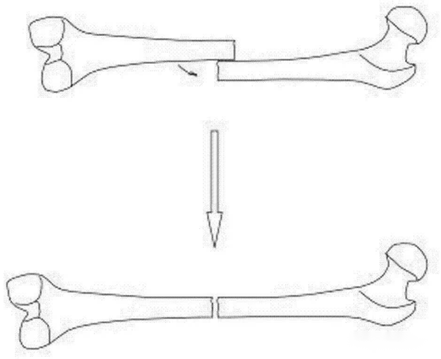 External Fixator - Basic Opera2