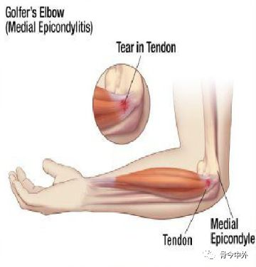 Formation and treatment of tennis elbow (2)