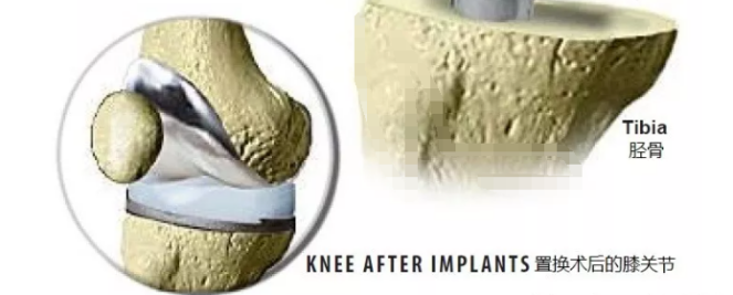 Knee replacement surgery2