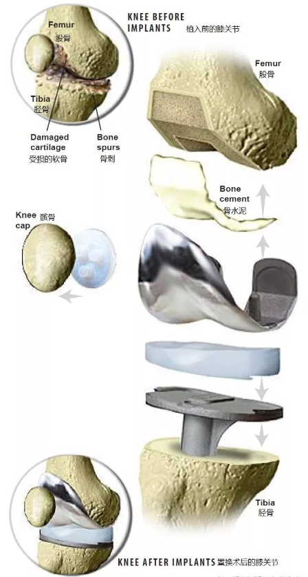 Knee replacement surgery3